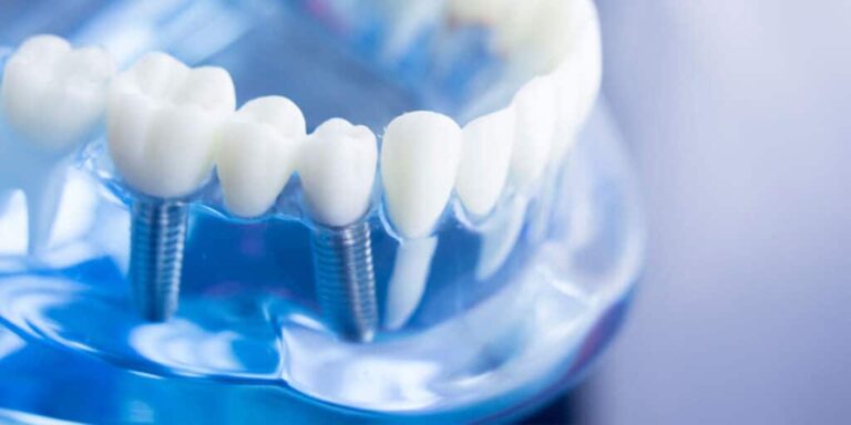 5 Important Benefits of Dental Implants in El Paso, TX