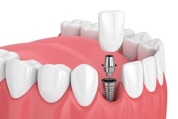Are You a Candidate for Dental Implants? An Assessment Guide