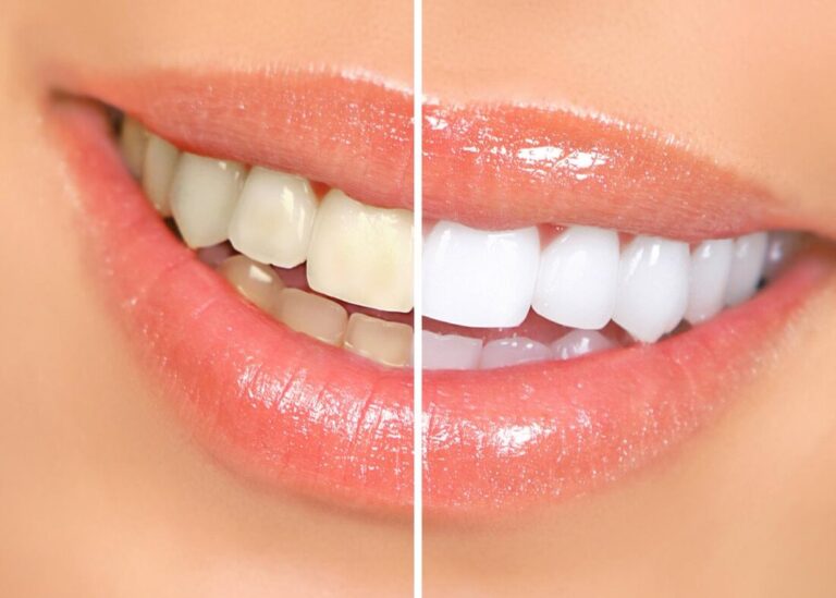 5 Great Benefits of Professional Teeth Whitening